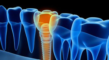 Dental Implants How They Can Benefit You